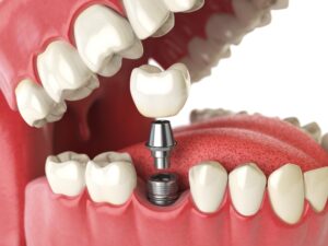 protheses-dentaires-sur-implant