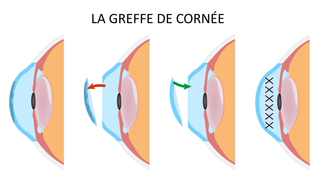 chirurgie-greffe-de-cornee